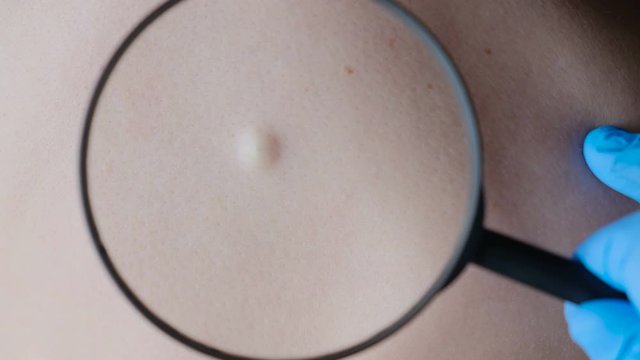 Atheroma on human skin through a magnifying glass, close-up