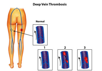 Deep-vein-thrombosis illustration