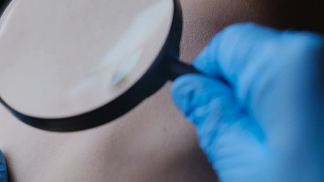 The doctor shows an atheroma or wen on the patient's body