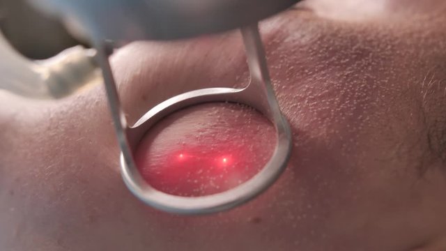 Extreme Close-Up Shot. A girl having laser skin treatment/laser resurfacing/laser facial peeling with Co2 laser in a cosmetology/plastic surgery clinic.