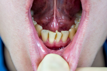 crooked teeth in the anterior part of the patient, at the reception of the orthodontist dentist,...