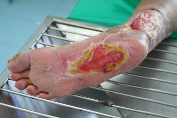 Close up diabetic foot ulcer , selective focus .
