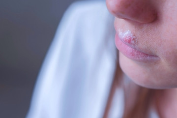 Herpes virus on human lips. Woman with herpes sore on lip mouth with ointment, closeup mouth....