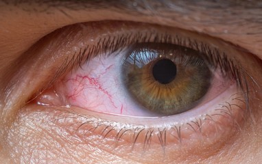 Close-up view on red injured or irritated eye.