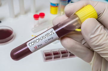 Hand holds test tube for Coronavirus 2019-nCOV analysis.