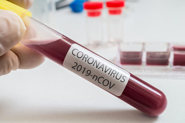 Hand holds test tube for Coronavirus 2019-nCOV analysis.