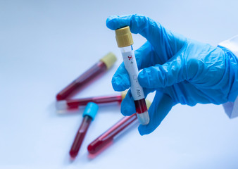 Sample blood collection tube with HIV test label
