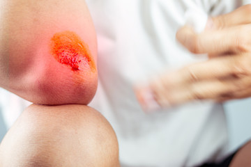 Close-up view of cleaning a bleeding wound under the shin After the accident, traumatic pain, burns.