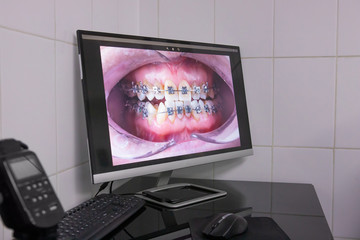 photograph of a jaw with braces on a computer monitor. Orthodontics, photographic protocol