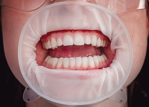 Teeth In The Mouth At The Dental Clinic, The Mouth Is Opened With A Cheek Retractor.