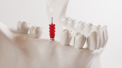 Tooth implantation picture series V02 - 5 of 8 - 3D Rendering