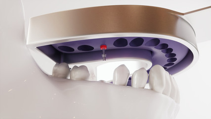 Tooth implantation picture series V02 - 6 of 8 - 3D Rendering
