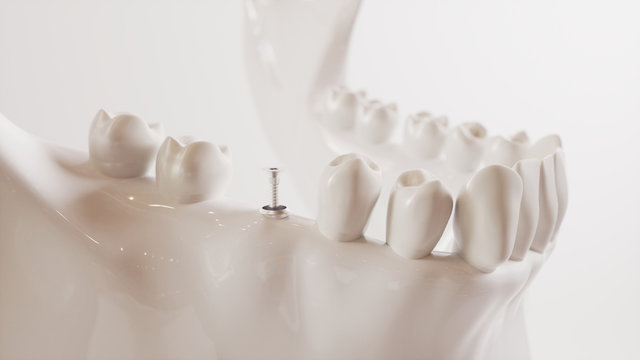 Tooth implantation picture series V02 - 4 of 8 - 3D Rendering