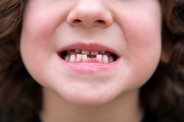 mouth of a small child who has moved a baby tooth and is growing the tooth