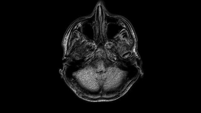 Voluminous MRI scans of the brain and head to detect tumors. Diagnostic medical tool