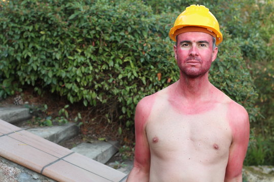 Sunburned construction worker with extreme tan lines