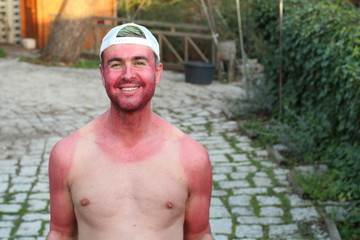 Sunburned young man with extreme tan lines 