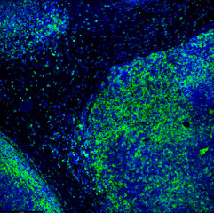 Tumour immunofluorescence IHC image of immunotherapy treatment. Tumor cells in blue attacked by immune system T cells lymphocytes in green