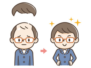 薄毛の進行　カツラ　ハゲ