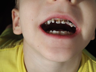 Abnormal boy tooth. The extra narrow strange tooth grew in the boy's mouth. Boy shows his crooked...
