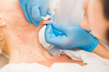 A doctor inserts needles under the skin on a patient's face - aesthetic medicine