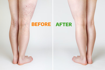 The concept of varicose veins and cosmetic treatment. Female legs with with and without vascular...