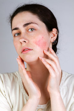 Portrait of a young Caucasian woman showing redness and inflamed blood vessels on her cheeks. Gray background. The concept of rosacea and couperose. Close up