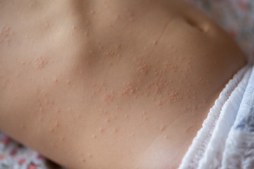 Large spots and pimples on the child’s body are sweating. Viral eczema, chickenpox or rubella,...