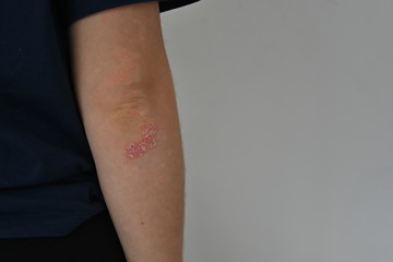 The skin of the girl is dry, there is drop-shaped psoriasis or dermatitis on the elbow. Close-up. Horizontal view. Copy space.