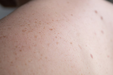 Checking benign moles. Close up detail of the bare skin on a man back with scattered moles and freckles.