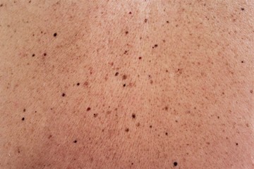 Birthmark,moles on man skin photo