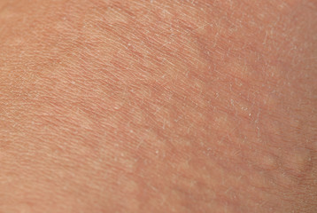 Fototapeta premium unhealthy irritated human skin texture covered with allergic bumps and blisters