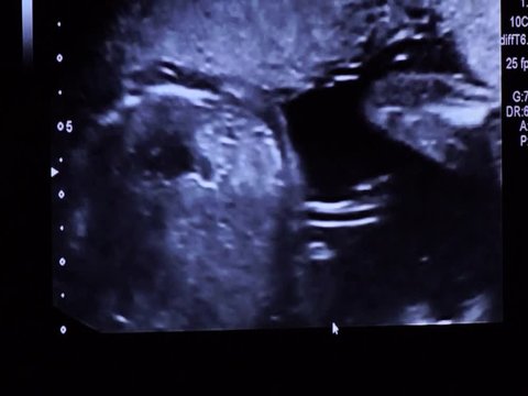 It's a boy! Ultrasound gender reveal with visible penis on the screen during 20 weeks exam