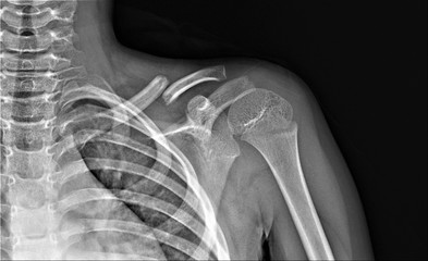 x- ray of the shoulder joint with a broken collarbone
