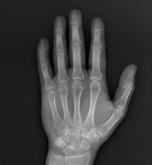 normal x-ray of the hand bones and fingers