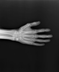 normal x-ray of the hand bones and fingers