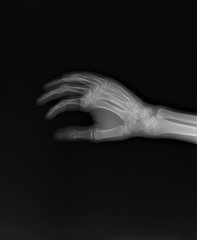 Fototapeta premium normal x-ray of the hand bones and fingers