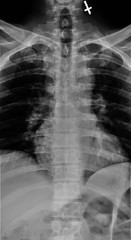 x-ray of the thoracic spine in a lateral projection