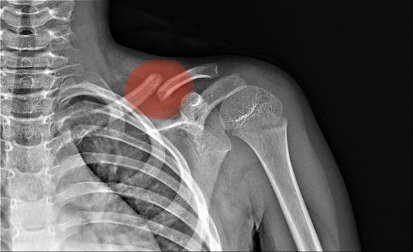 x-ray with a broken collarbone of an eight-year-old child