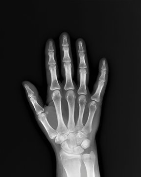 normal x-ray of the hand bones and fingers