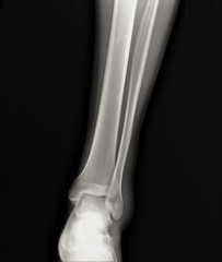 normal radiography of the ankle joint in the lateral projection