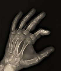 x-ray of the hand with a fractured phalanx of the third finger