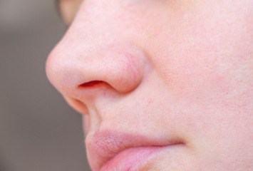 the girl has red capillaries on her nose - obrazy, fototapety, plakaty