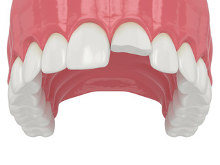 3d render of upper jaw with broken incisor tooth © Aleksandra Gigowska