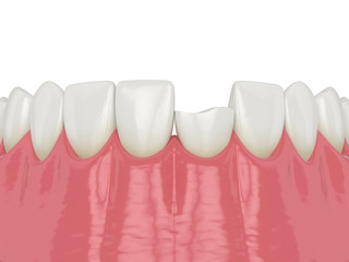 3d render of lower jaw with broken incisor tooth