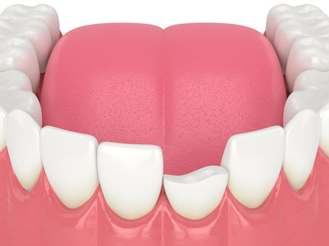 3d render of lower jaw with broken incisor tooth