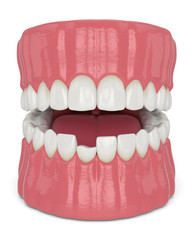3d render of opened jaw with broken incisor lower tooth