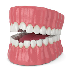 3d render of jaw with broken incisors teeth