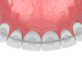 3d render of dental bonded retainer on upper jaw