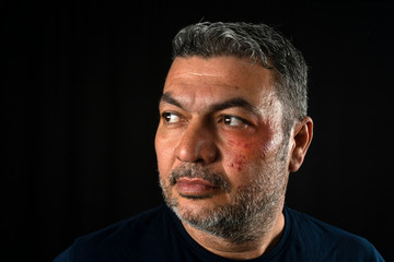 portrait of mature man with injured face